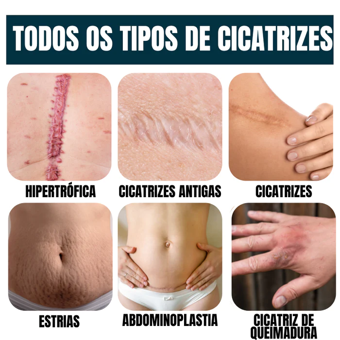 Gel Scar® 100% Advanced Gel - Para todos os Tipos de Cicatrizazes (cesariana, abdominoplastia, cicatrizes antigas, queloides, estrias, queimaduras)